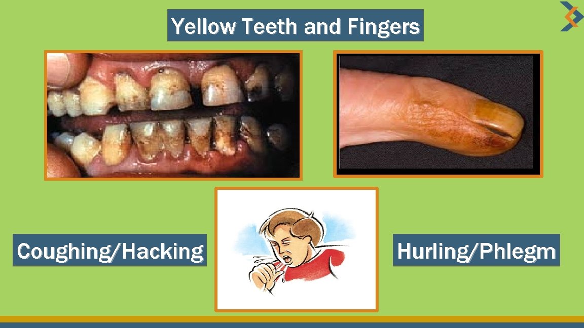 Yellow Teeth and Fingers Coughing/Hacking Hurling/Phlegm 