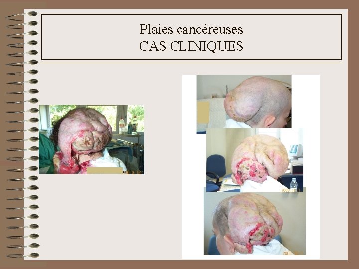 Plaies cancéreuses CAS CLINIQUES Plaies cancéreuses CAS CLINIQUES