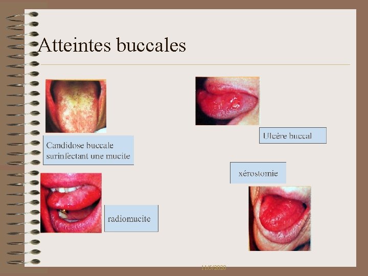 Atteintes buccales 11/5/2020 Atteintes buccales 11/5/2020
