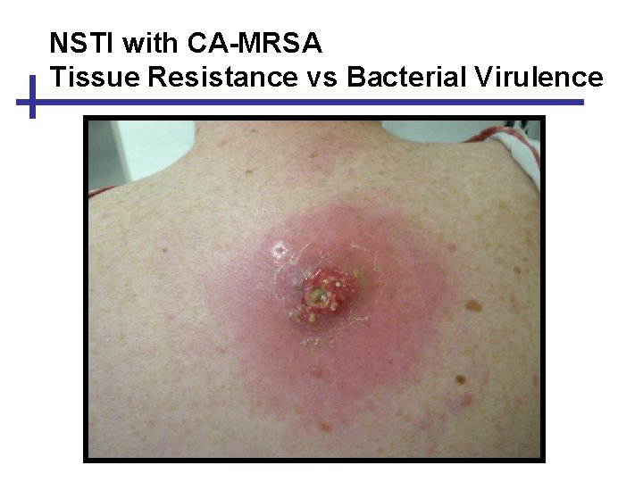 NSTI with CA-MRSA Tissue Resistance vs Bacterial Virulence 