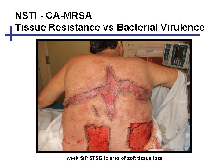 NSTI - CA-MRSA Tissue Resistance vs Bacterial Virulence 1 week S/P STSG to area