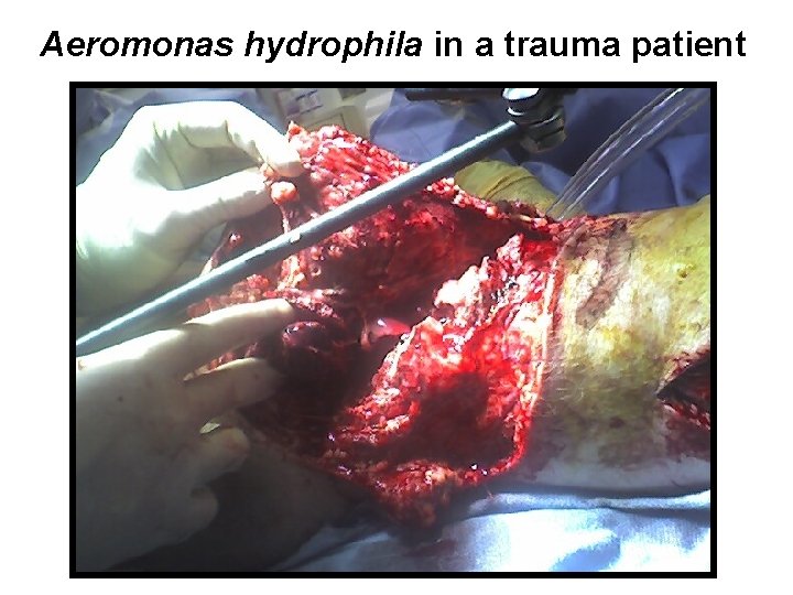 Aeromonas hydrophila in a trauma patient 