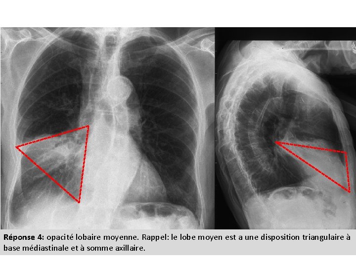 Réponse 4: opacité lobaire moyenne. Rappel: le lobe moyen est a une disposition triangulaire