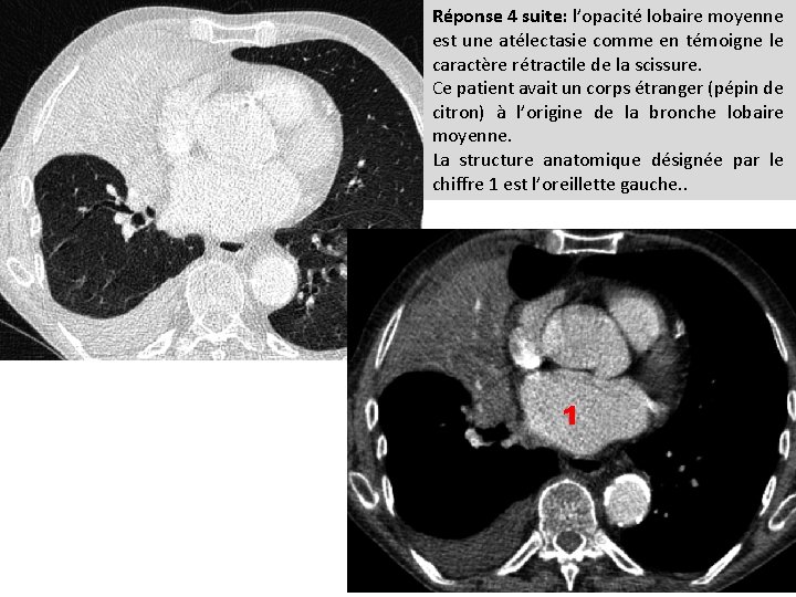 Réponse 4 suite: l’opacité lobaire moyenne est une atélectasie comme en témoigne le caractère