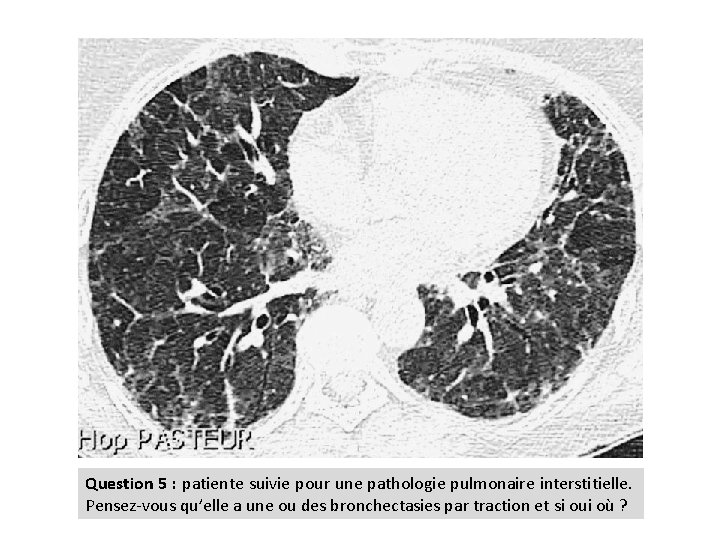 Question 5 : patiente suivie pour une pathologie pulmonaire interstitielle. Pensez-vous qu’elle a une