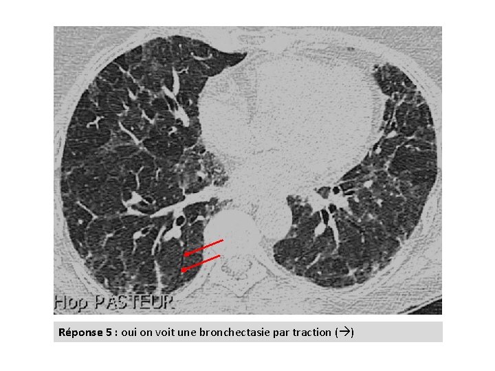 Réponse 5 : oui on voit une bronchectasie par traction ( ) 