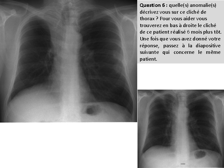 Question 6 : quelle(s) anomalie(s) décrivez vous sur ce cliché de thorax ? Pour