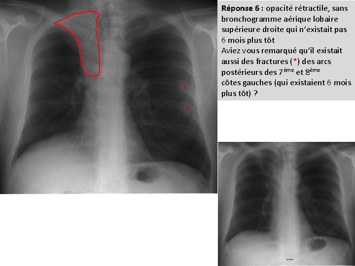 * * Réponse 6 : opacité rétractile, sans bronchogramme aérique lobaire supérieure droite qui