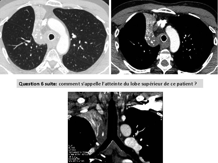 Question 6 suite: comment s’appelle l’atteinte du lobe supérieur de ce patient ? 