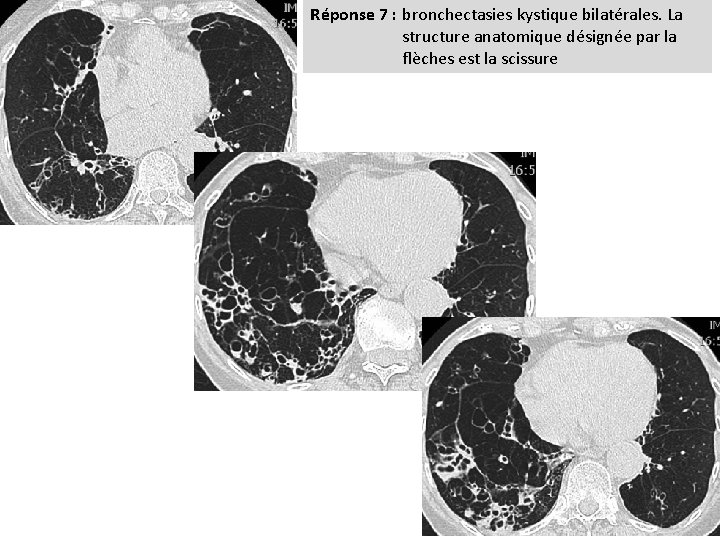 Réponse 7 : bronchectasies kystique bilatérales. La structure anatomique désignée par la flèches est