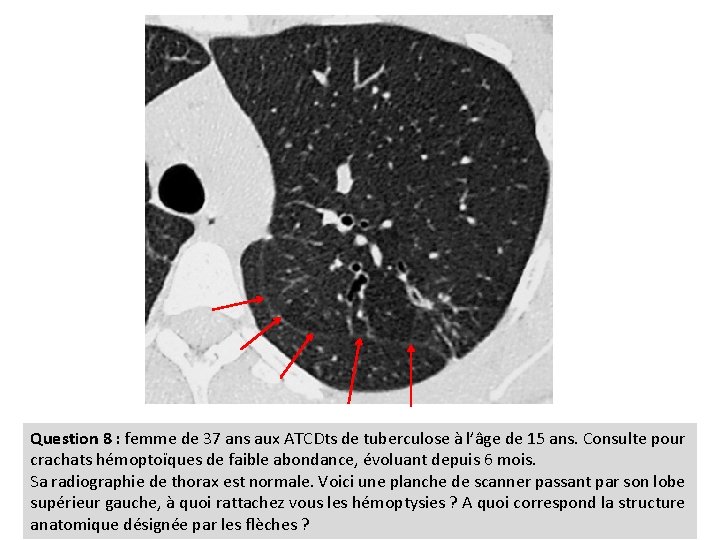 Question 8 : femme de 37 ans aux ATCDts de tuberculose à l’âge de