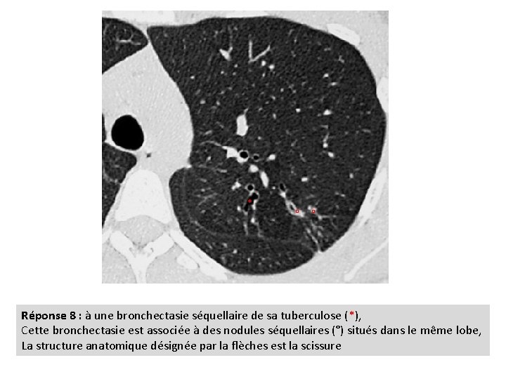 * ° ° Réponse 8 : à une bronchectasie séquellaire de sa tuberculose (*),