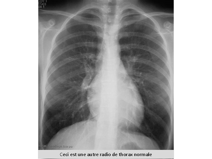 Ceci est une autre radio de thorax normale 