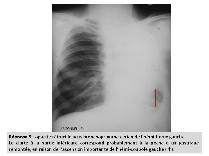 Réponse 9 : opacité rétractile sans bronchogramme aérien de l’hémithorax gauche. La clarté à