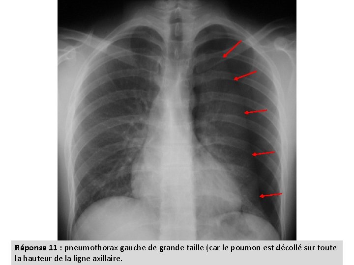 Réponse 11 : pneumothorax gauche de grande taille (car le poumon est décollé sur