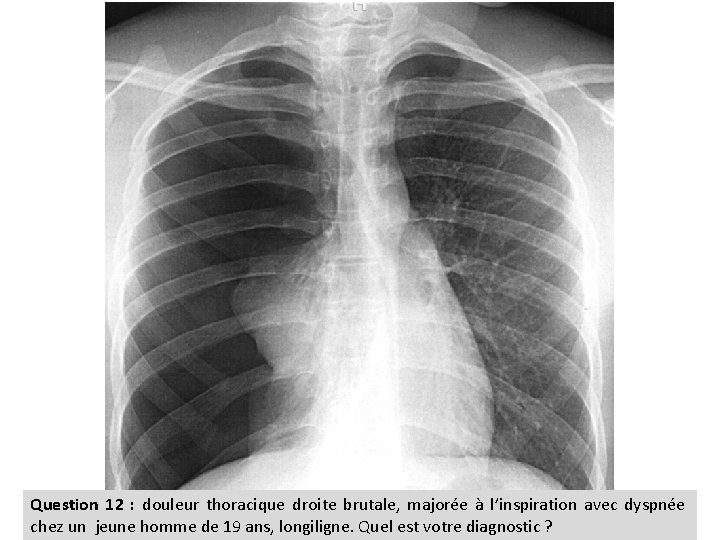 Question 12 : douleur thoracique droite brutale, majorée à l’inspiration avec dyspnée chez un