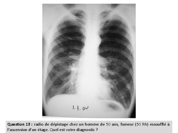 Question 13 : radio de dépistage chez un homme de 50 ans, fumeur (50