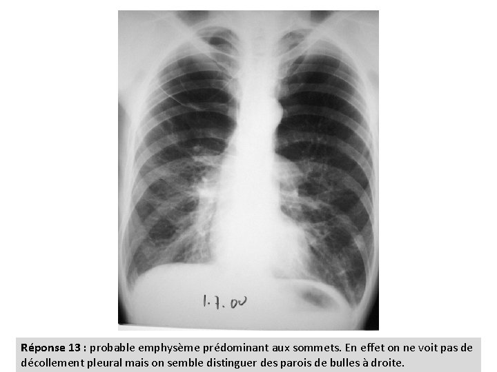 Réponse 13 : probable emphysème prédominant aux sommets. En effet on ne voit pas