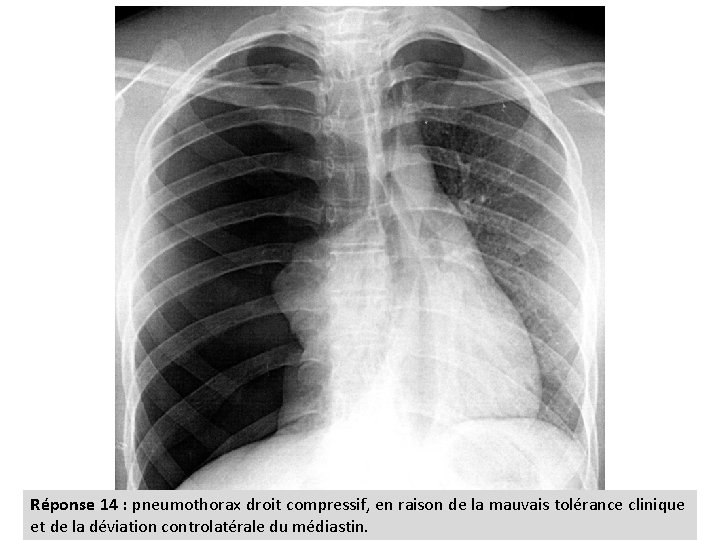 Réponse 14 : pneumothorax droit compressif, en raison de la mauvais tolérance clinique et