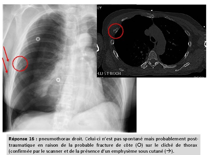 Réponse 16 : pneumothorax droit. Celui-ci n’est pas spontané mais probablement posttraumatique en raison