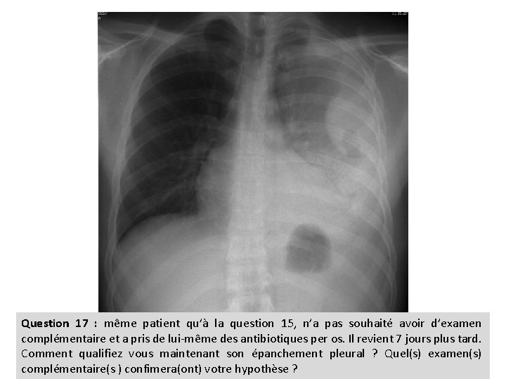 Question 17 : même patient qu’à la question 15, n’a pas souhaité avoir d’examen