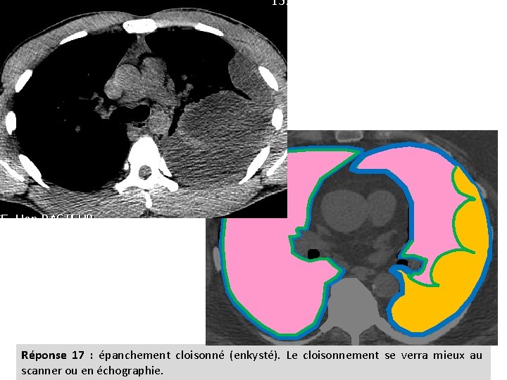 Réponse 17 : épanchement cloisonné (enkysté). Le cloisonnement se verra mieux au scanner ou