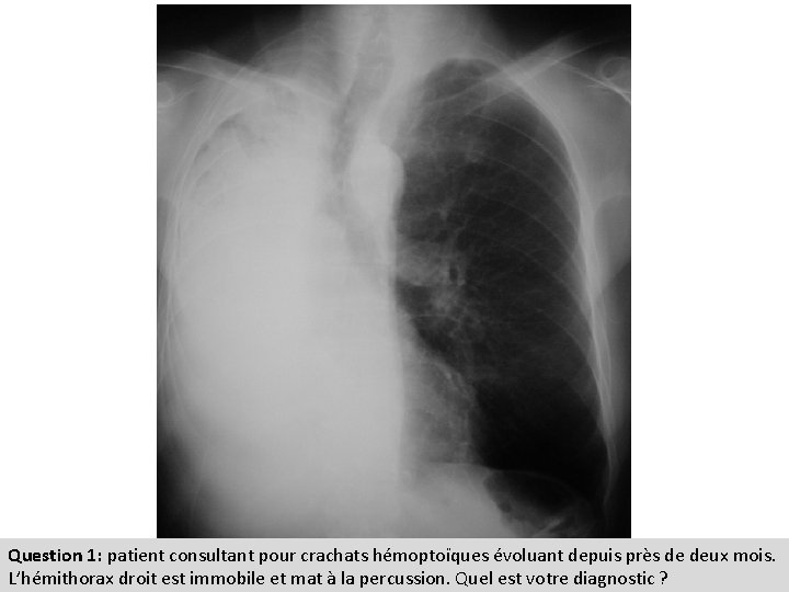 Question 1: patient consultant pour crachats hémoptoïques évoluant depuis près de deux mois. L’hémithorax