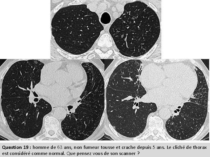 Question 19 : homme de 63 ans, non fumeur tousse et crache depuis 5