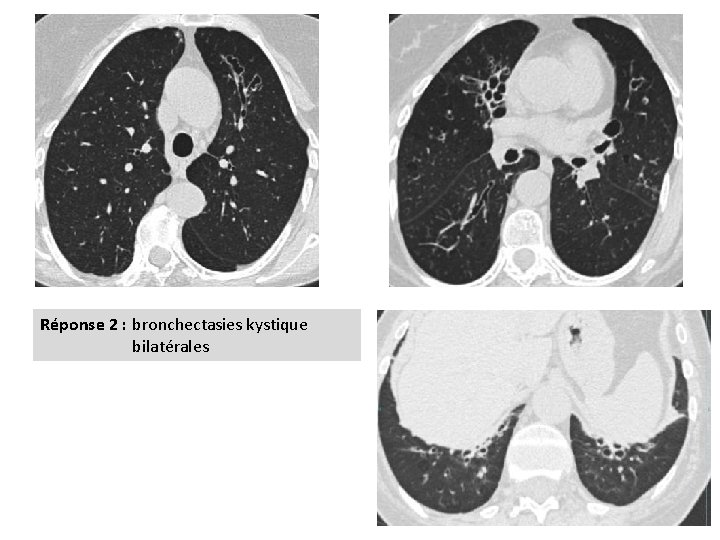 Réponse 2 : bronchectasies kystique bilatérales 