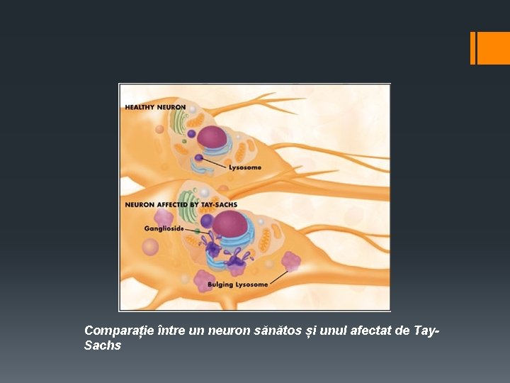 Comparație între un neuron sănătos și unul afectat de Tay. Sachs 