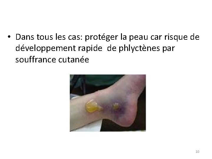  • Dans tous les cas: protéger la peau car risque de développement rapide