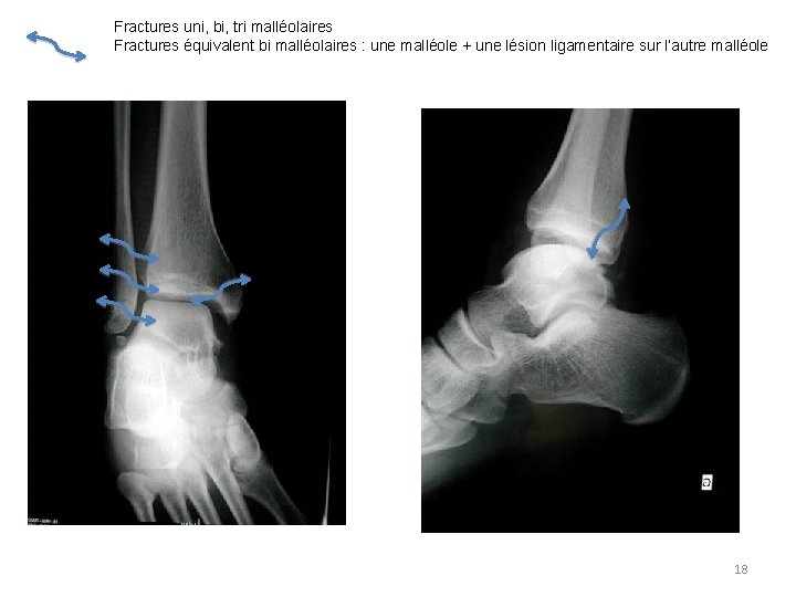 Fractures uni, bi, tri malléolaires Fractures équivalent bi malléolaires : une malléole + une