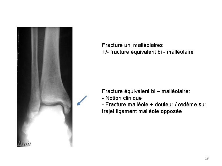 Fracture uni malléolaires +/- fracture équivalent bi - malléolaire Fracture équivalent bi – malléolaire: