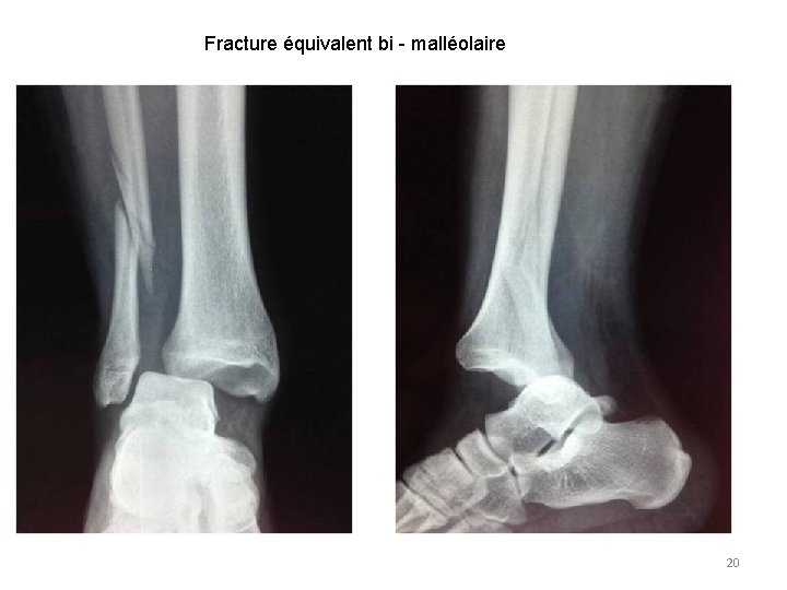 Fracture équivalent bi - malléolaire 20 