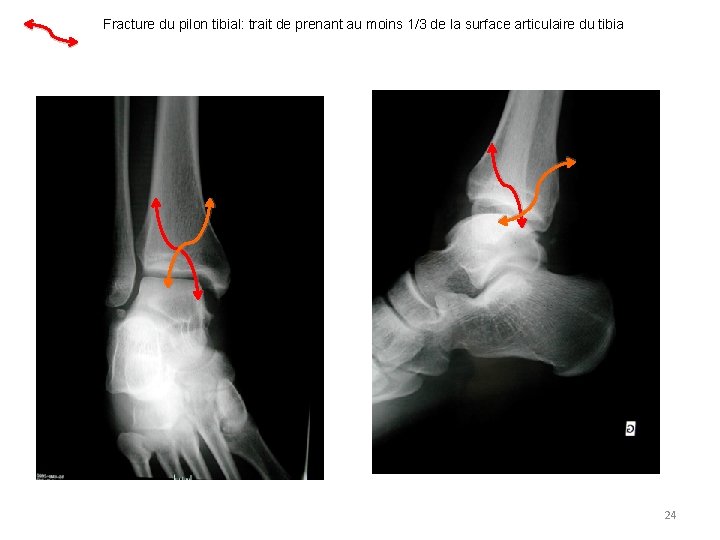 Fracture du pilon tibial: trait de prenant au moins 1/3 de la surface articulaire