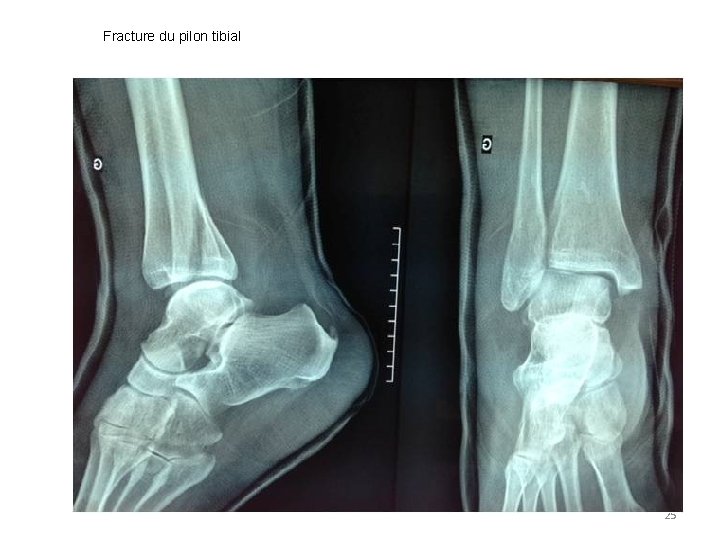 Fracture du pilon tibial 25 