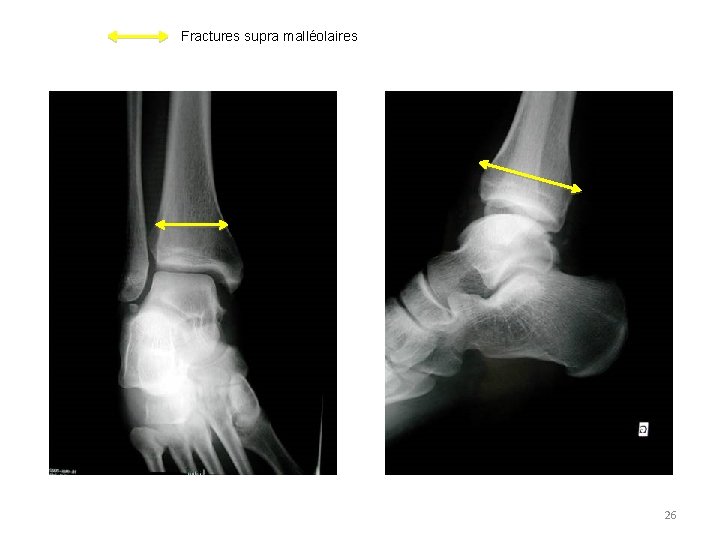 Fractures supra malléolaires 26 