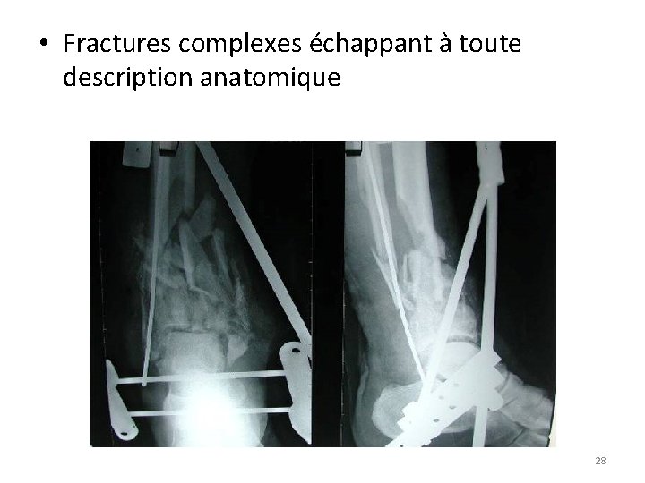  • Fractures complexes échappant à toute description anatomique 28 