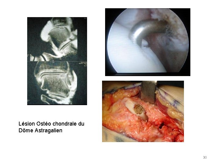 Lésion Ostéo chondrale du Dôme Astragalien 30 