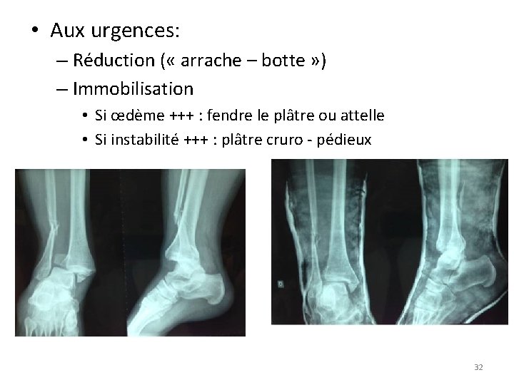  • Aux urgences: – Réduction ( « arrache – botte » ) –