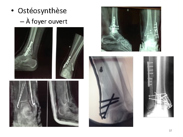  • Ostéosynthèse – À foyer ouvert 37 