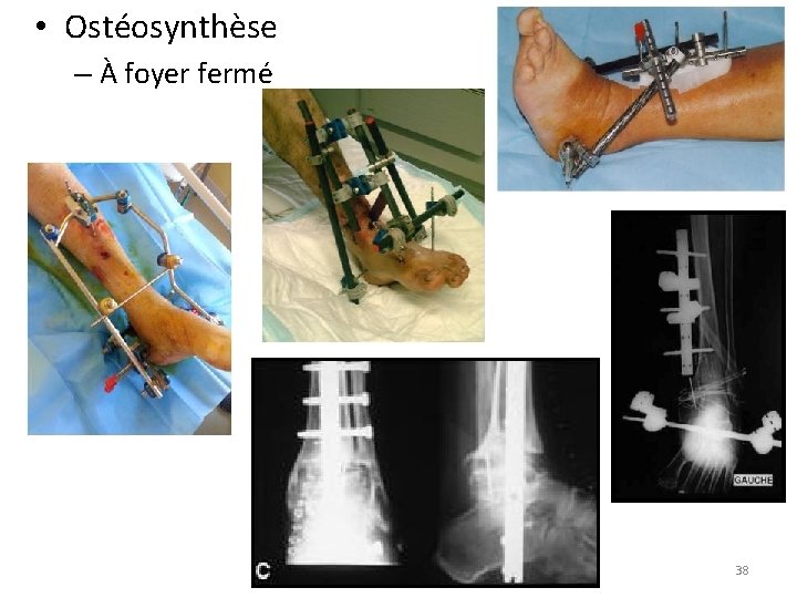  • Ostéosynthèse – À foyer fermé 38 