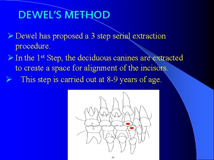 DEWEL’S METHOD Ø Dewel has proposed a 3 step serial extraction procedure. Ø In