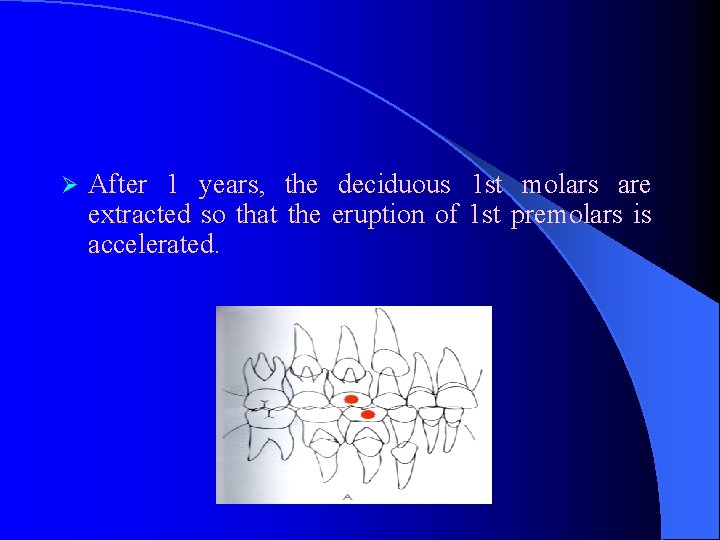 Ø After 1 years, the deciduous 1 st molars are extracted so that the