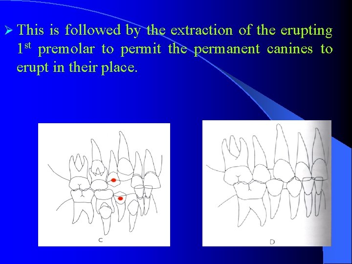 Ø This is followed by the extraction of the erupting 1 st premolar to