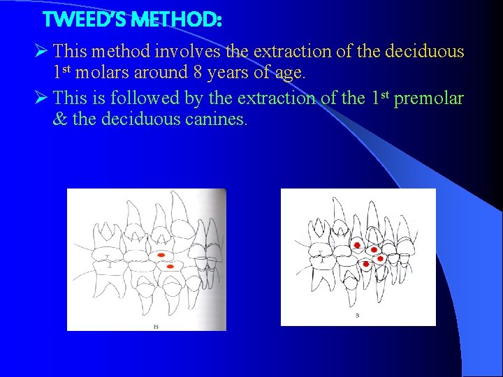 TWEED’S METHOD: Ø This method involves the extraction of the deciduous 1 st molars