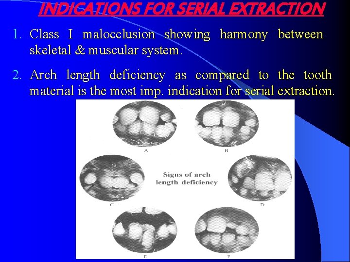 INDICATIONS FOR SERIAL EXTRACTION 1. Class I malocclusion showing harmony between skeletal & muscular