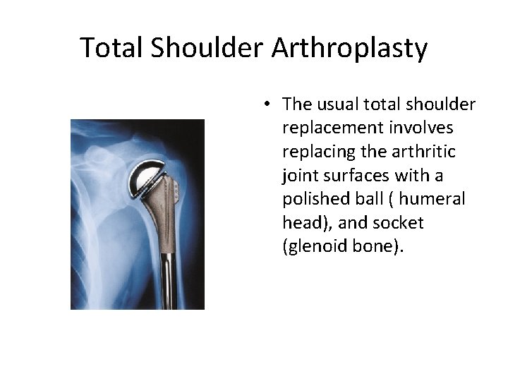 Total Shoulder Arthroplasty • The usual total shoulder replacement involves replacing the arthritic joint