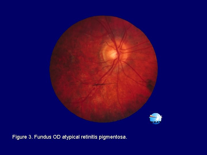Figure 3. Fundus OD atypical retinitis pigmentosa. 