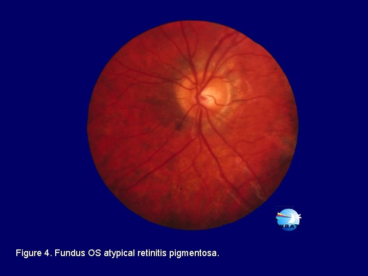 Figure 4. Fundus OS atypical retinitis pigmentosa. 